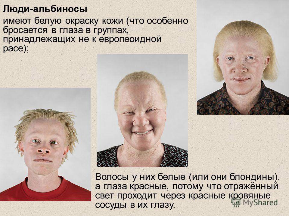 Альбинизм
