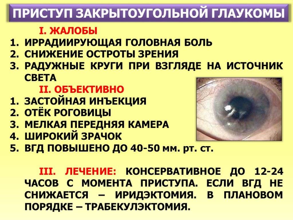Закрытоугольная глаукома: причины, симптомы, лечение
