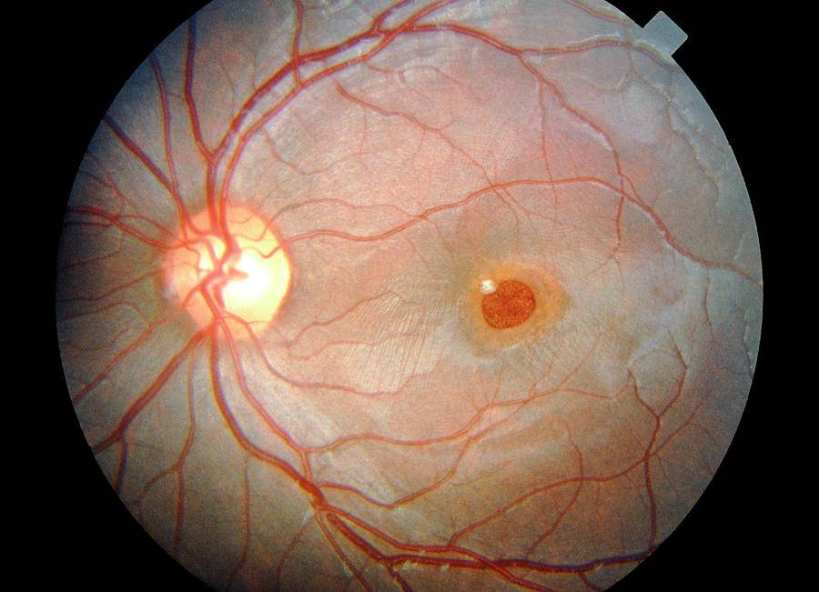 Исследование глазного дна (офтальмоскопия): показания, как проводится