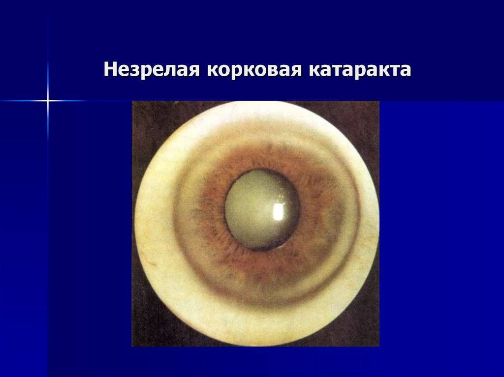 Старческая катаракта: причины, симптомы и лечение