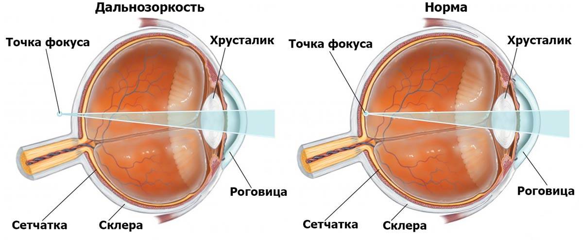 Основные степени гиперметропии глаза