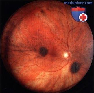 Что такое невус хориоидеи глаза: виды и лечение