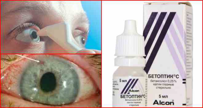 Глазное давление - симптомы и лечение лекарствами или народными средствами