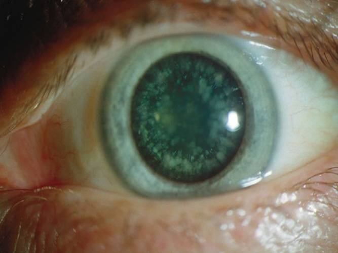 Что такое незрелая катаракта — стоит ли делать операцию