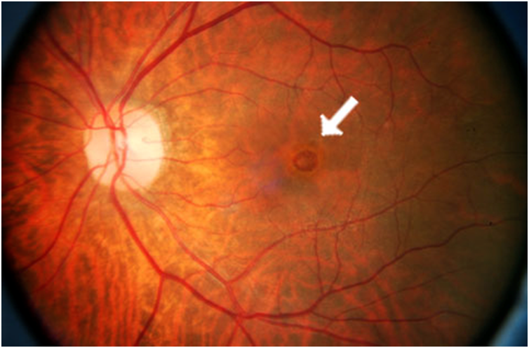 Макулярный разрыв сетчатки глаза: причины и лечение
