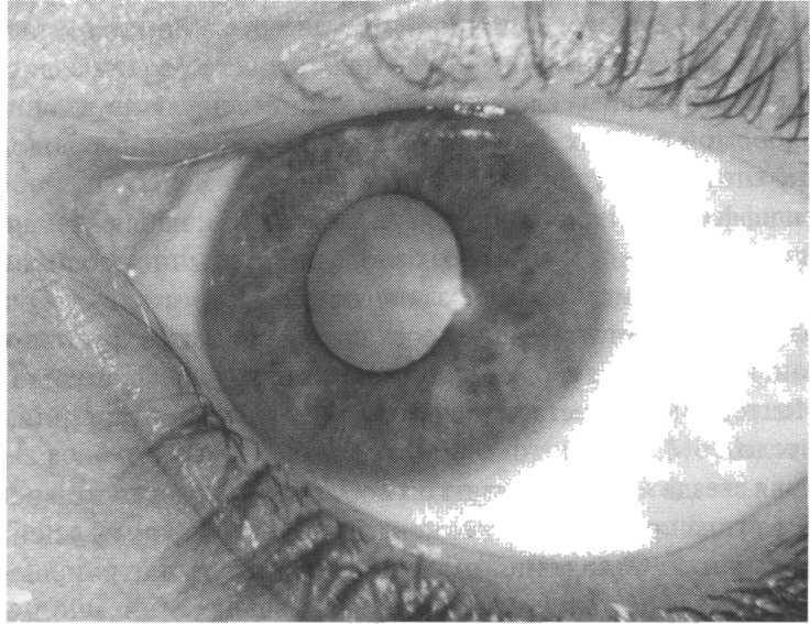 Врожденная катаракта у детей: категории детей с нарушениями зрения, каковы виды, причины возникновения такого заболевания и лечение