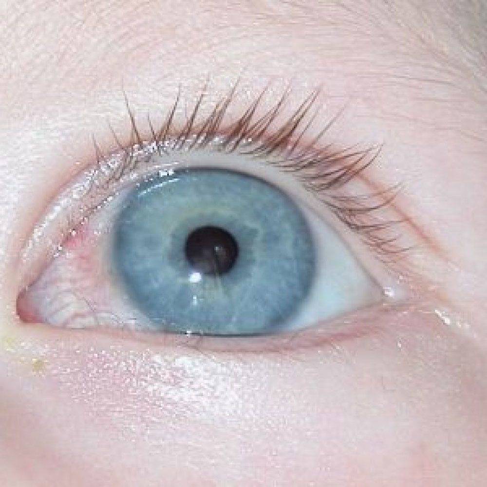 Нарост на глазу: виды и причины появления жёлтого или белого образования на глазном яблоке, лечение