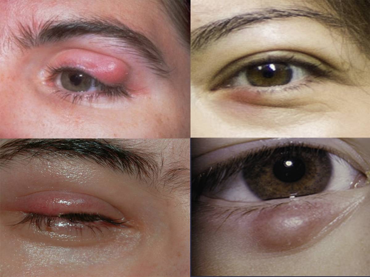Что это: лёгкое покраснение или характерный симптом воспаления? начальная стадия ячменя на глазу, фото