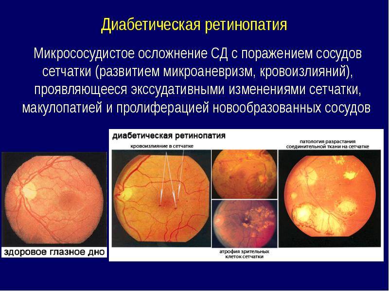 Диабетическая ретинопатия - что это такое, лечение, симптомы