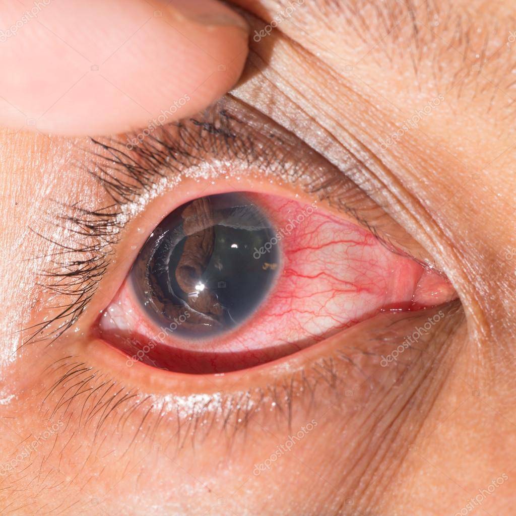 Гифема или кровоизлияние в переднюю камеру глаза