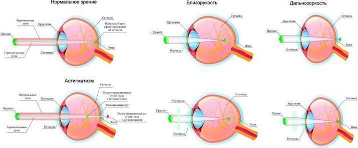 Чем опасен астигматизм глаз: первые признаки и современные методы лечения