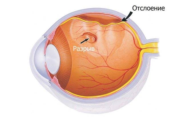 Как лечить отслоение сетчатки глаза полное и на начальной стадии - можно ли вылечить народными средствами и глазными каплями