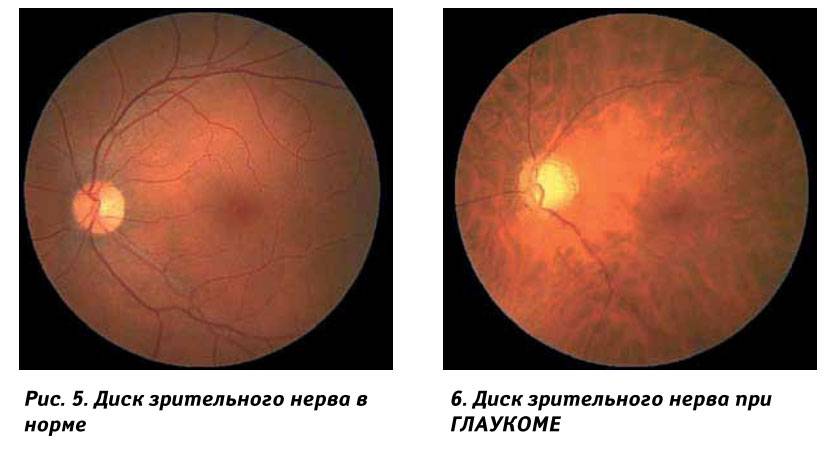 Лечение зрительного нерва