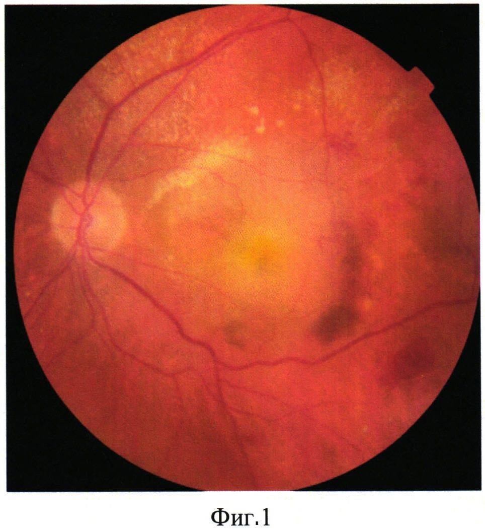Возрастная макулодистрофия сетчатки глаза (вмд) - лечение влажной и сухой формы