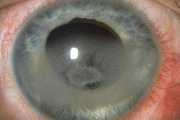 Ксероз роговицы глаза - что это, лечение, причины и симптомы