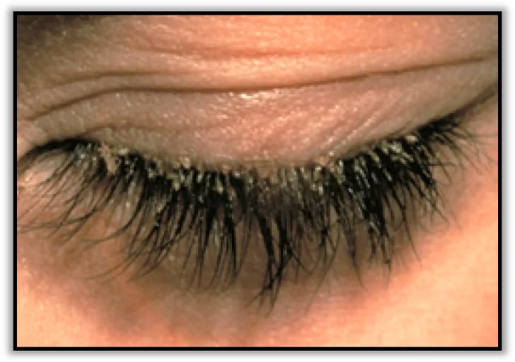 Блефарит: симптомы, фото, лечение блефарита глаза