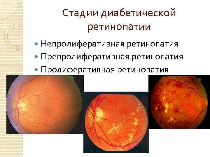 Диабетическая ретинопатия – поражение глаз при сахарном диабете