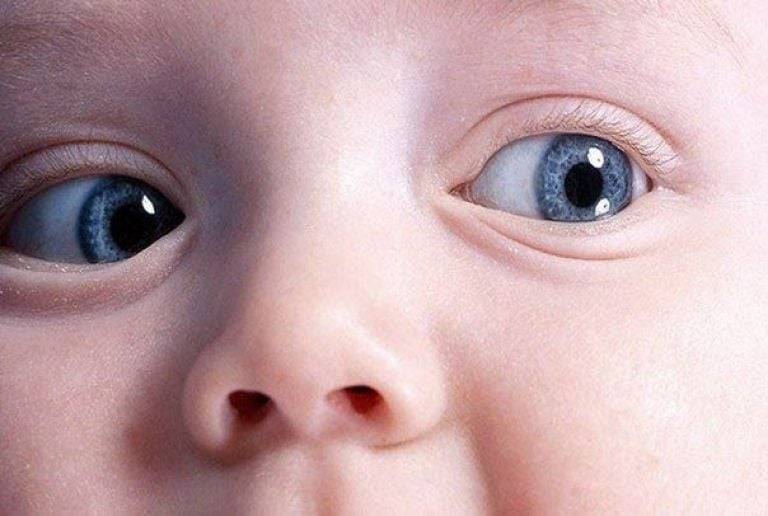 Анизокория: почему у младенцев бывают разные зрачки?