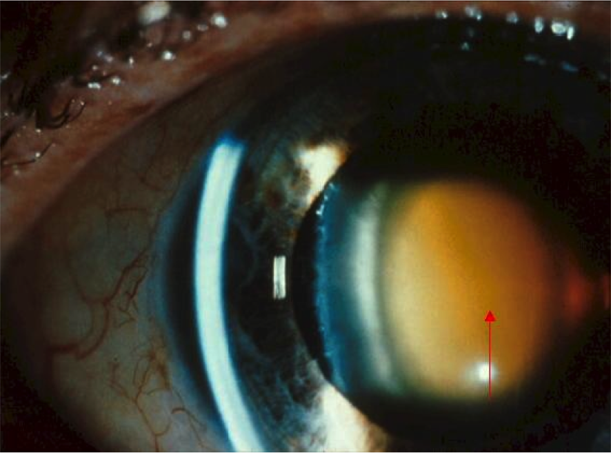 Ядерная катаракта: причины, симптомы, лечение, что это такое, болезнь у пожилых людей, профилактика