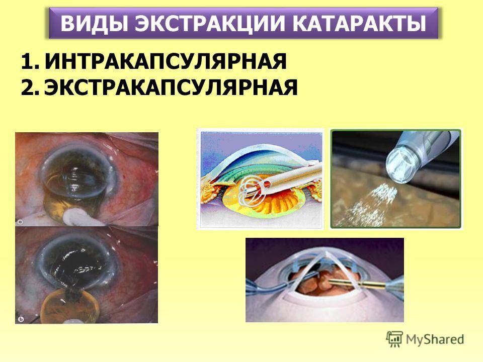 Экстракция катаракты (интракапсулярная иэк, экстракапсулярная ээк) с имплантацией иол: виды операций, этапы, реабилитация, осложнения, цена