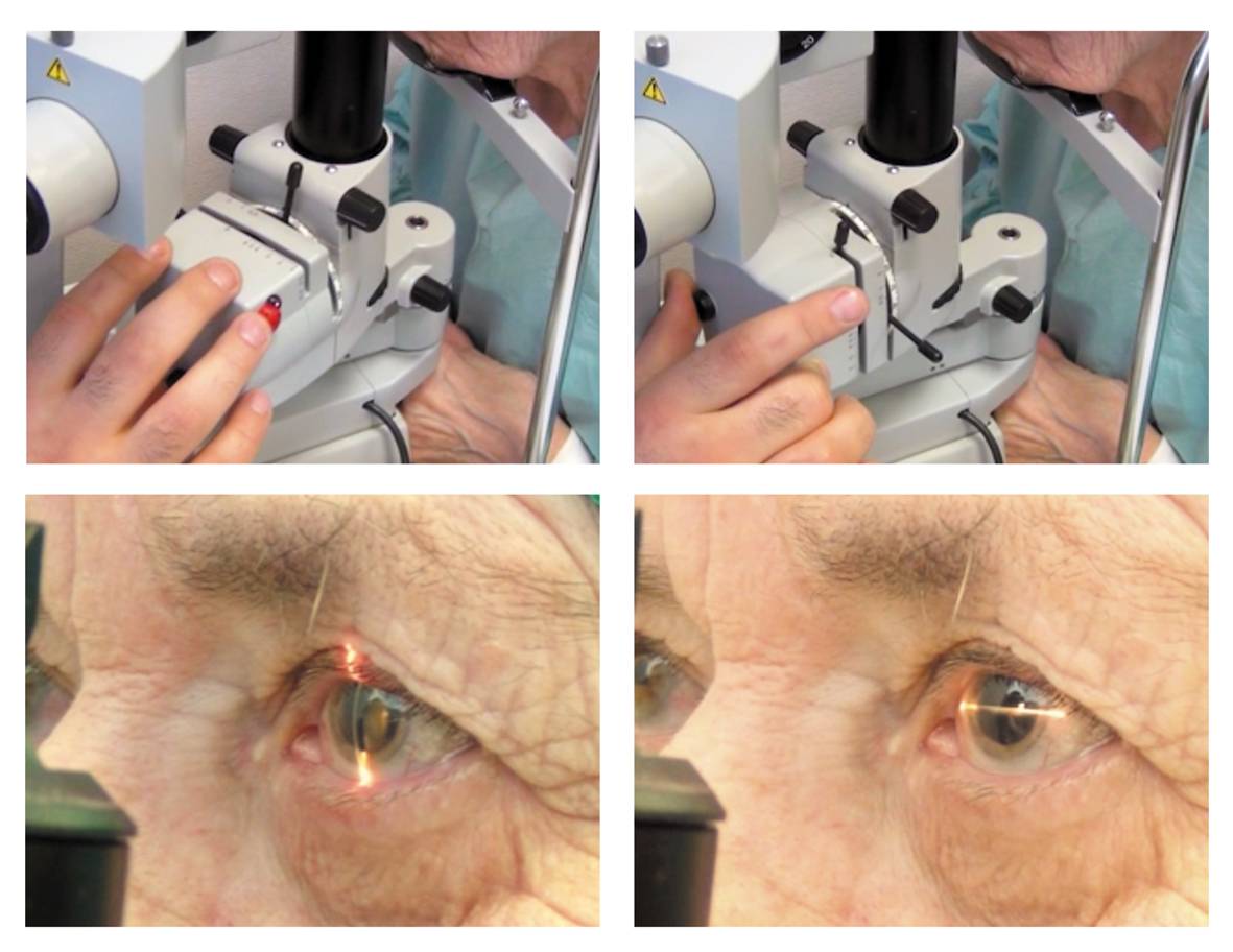 Операция - катаракта на глазе, удаление старческой перезрелой