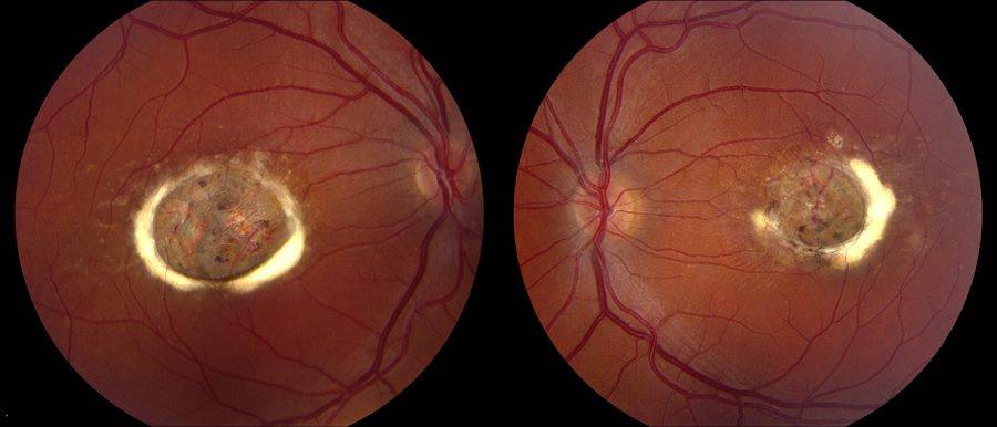 Заболевания сетчатки глаза: лечение патологий и дефектов народными средствами, симптомы поражений