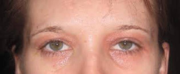 Аллергия вокруг глаз: причины, симптомы, лечение, меры профилактики