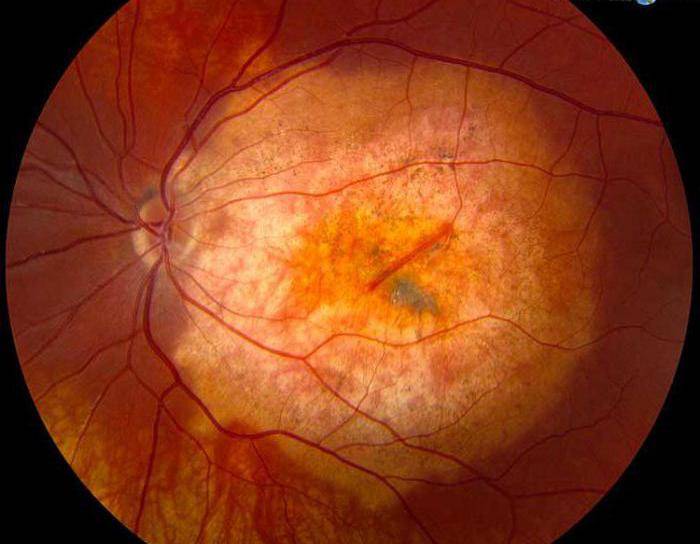 Полный список заболеваний сетчатки глаза: диагностика и лечение проблем зрительной системы