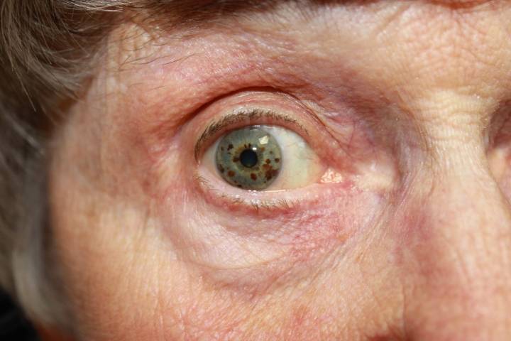 Наиболее эффективное и безопасное лечение глаукомы у пожилых людей