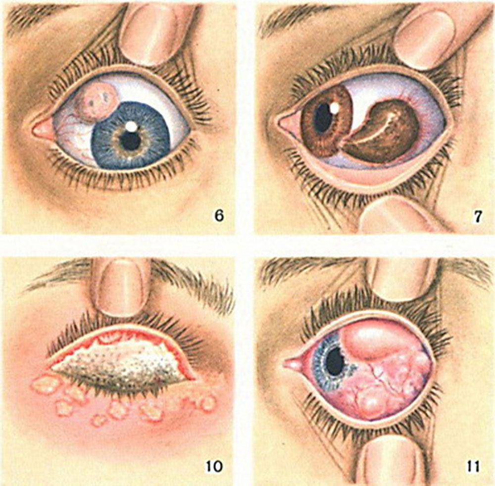Трахома глаз - признаки заболевания и возможные осложнения