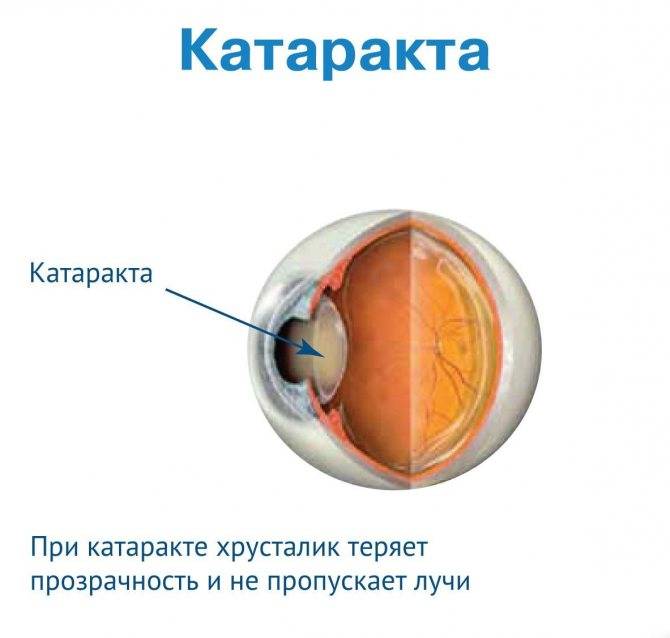 Врожденная катаракта у детей и взрослых: причины, симптомы, что делать при наличии заболевания