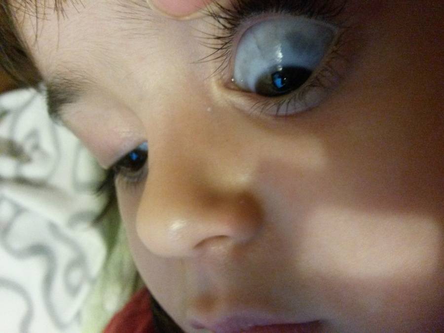 Красное пятно в глазу у ребенка - что это, лечение, причины, симптомы
