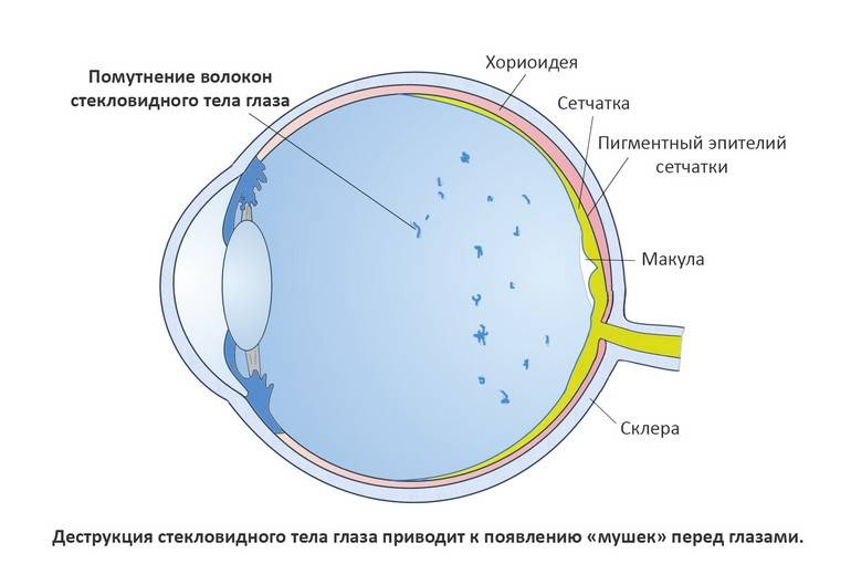 Мушки перед глазами: причины мелькания мушек перед глазами и лечение