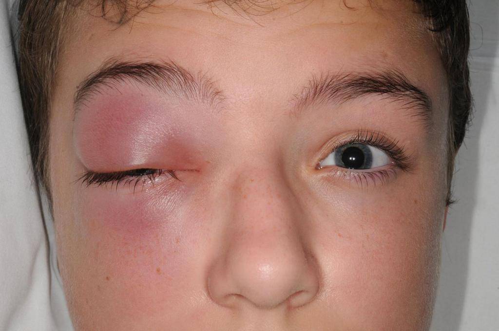 Отек глаз при аллергии у ребенка и взрослого: как быстро снять
