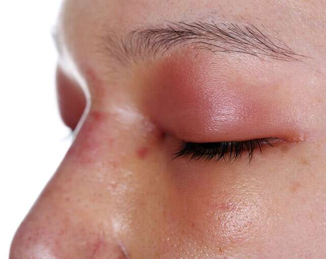 Дерматит век: причины воспаления кожи вокруг глаз, методы лечения болезни у детей и взрослых