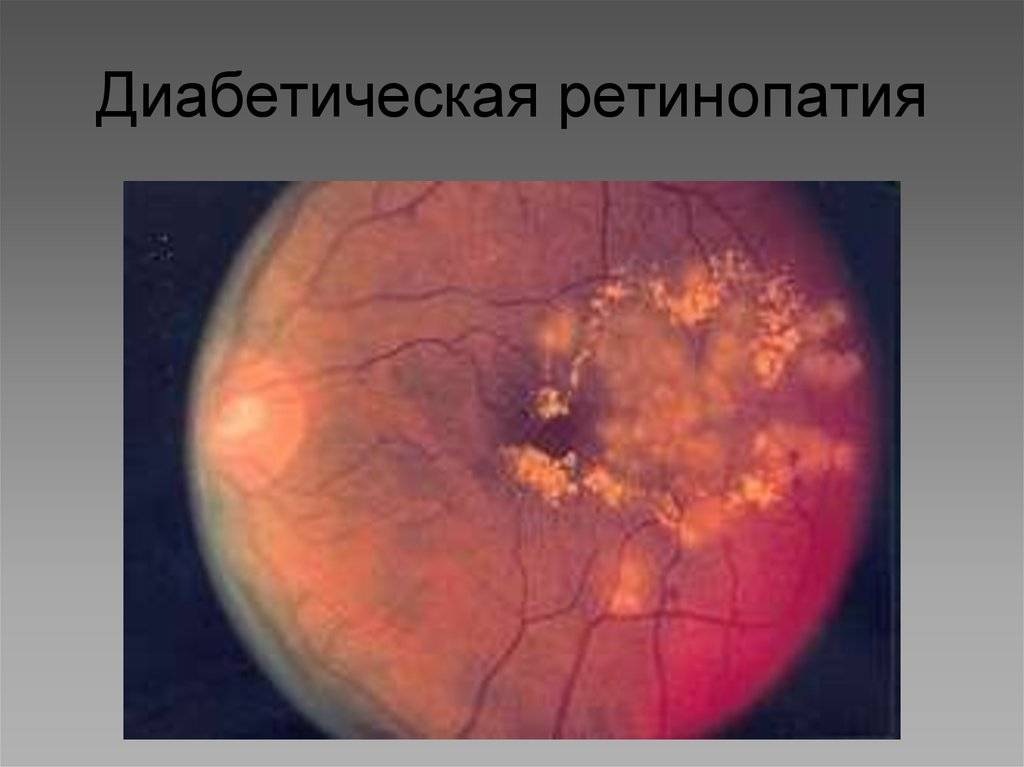 Диабетическая ретинопатия: что это такое, симптомы, лечение и стадии