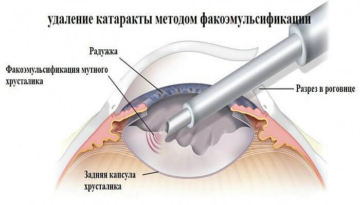 Факоэмульсификация — современный метод лечения катаракты