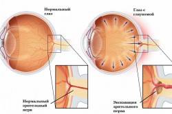 Основные причины развития глаукомы