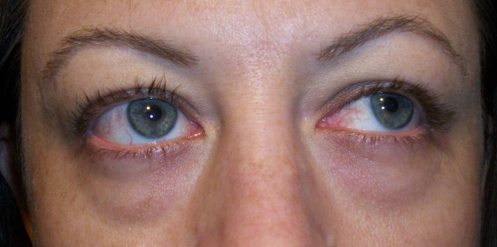 Синяки в уголках глаз у переносицы - причины появления, как убрать