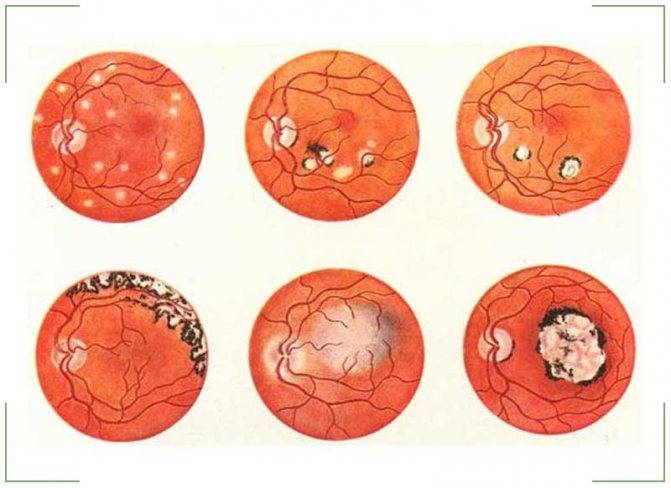 Центральная серозная хориоретинопатия сетчатки - причины, симптомы и эффективные методы лечения заболевания
