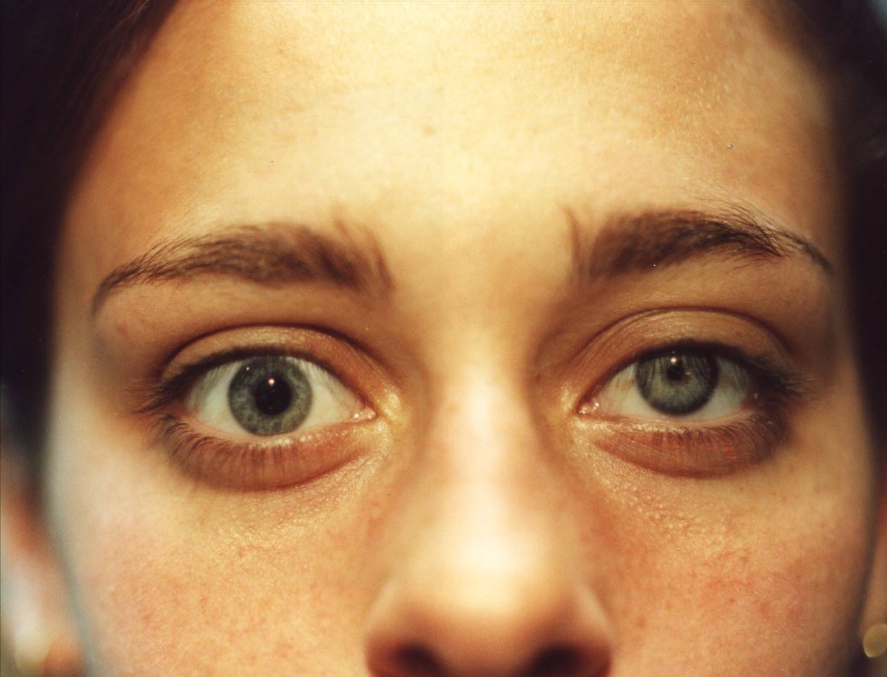 Анизокория глаза: причины, лечение, симптомы и диагностика