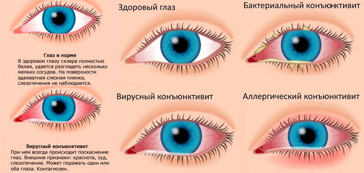 Косоглазие у взрослых фото