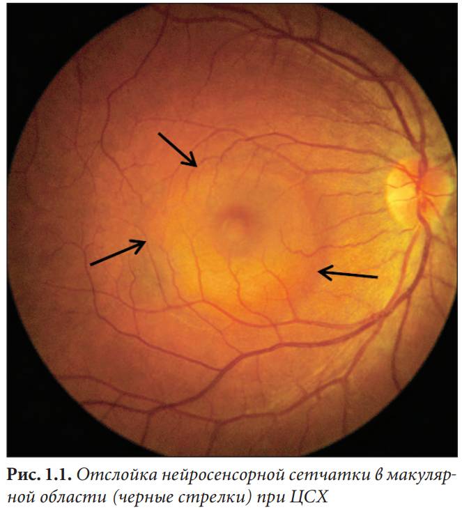 Разрыв сетчатки глаза – причины, симптомы и лечение