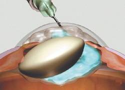 Интракапсулярная экстракция катаракты ход операции