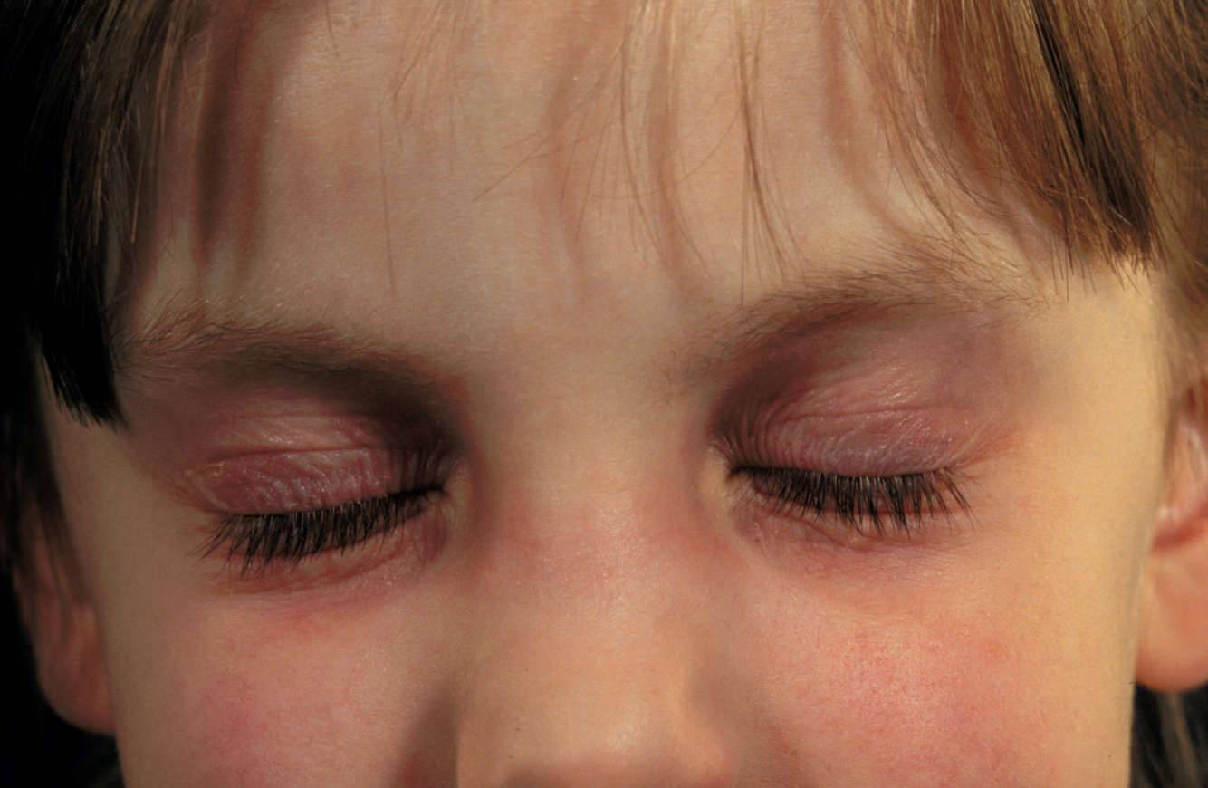 Аллергия у ребенка - причины, лечение и 140 фото лучших препаратов для детей