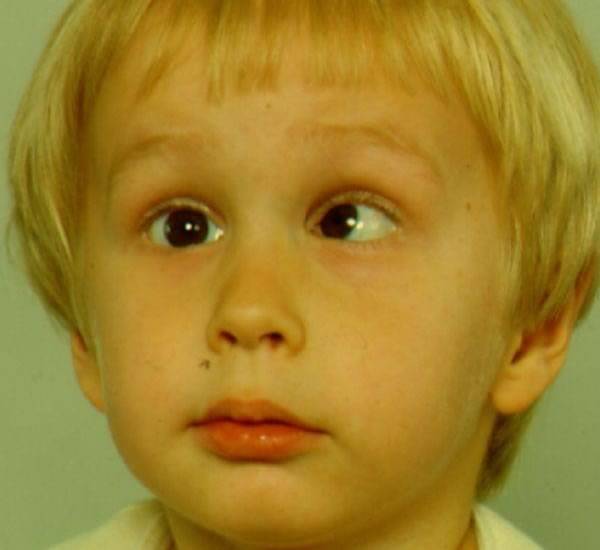 Амблиопия глаз у детей – причины, симптомы и лечение (фото)