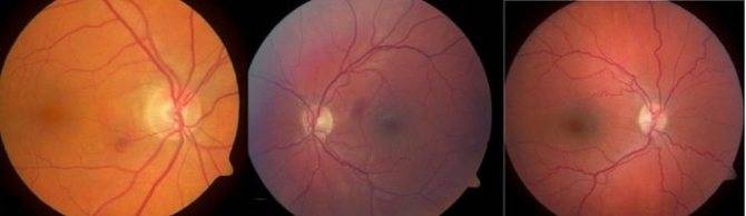 Что такое ангиопатия сетчатки глаза: причины и симптомы, лечение и профилактика патологического состояния