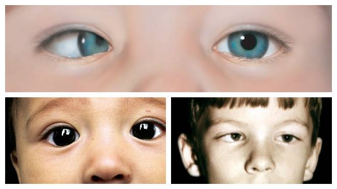 Косоглазие у детей: причины появления и способы его диагностики — глаза эксперт
