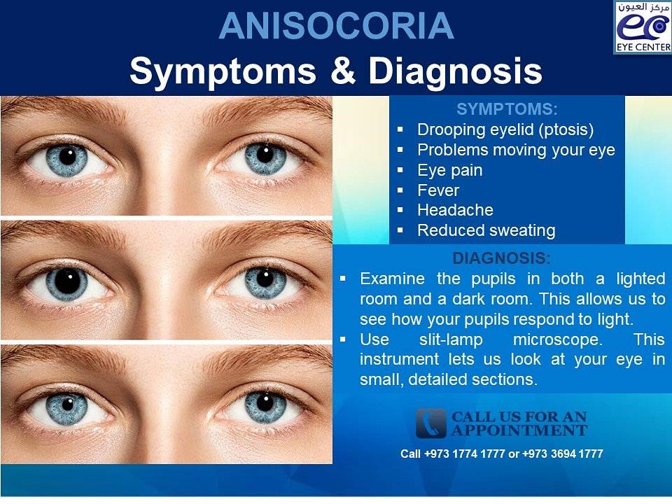 Анизокория: причины и лечение разных по размеру зрачков у взрослых и детей