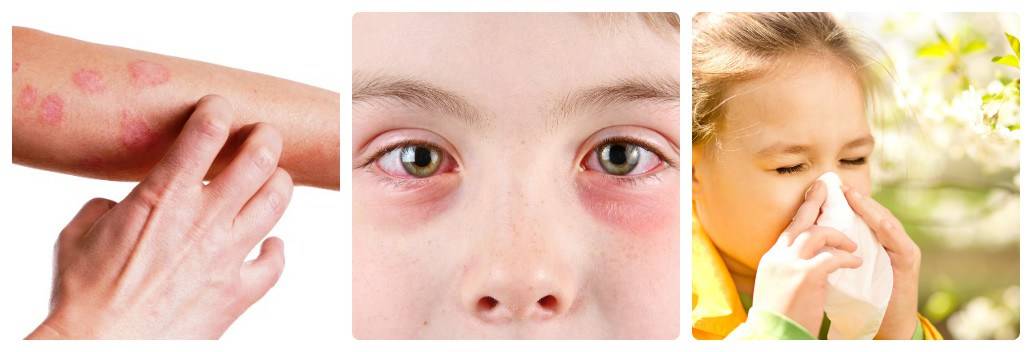 Почему у ребенка при простуде и орви гноятся глаза